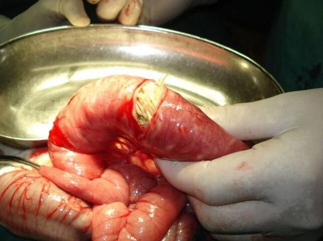 worms in the human intestine