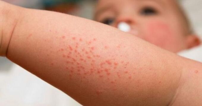 skin rash as a sign of parasite infection