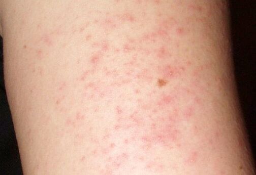 An itchy skin rash is a sign of worms in the liver