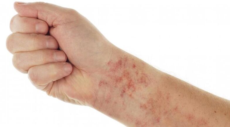 skin rashes in the presence of parasites on the body